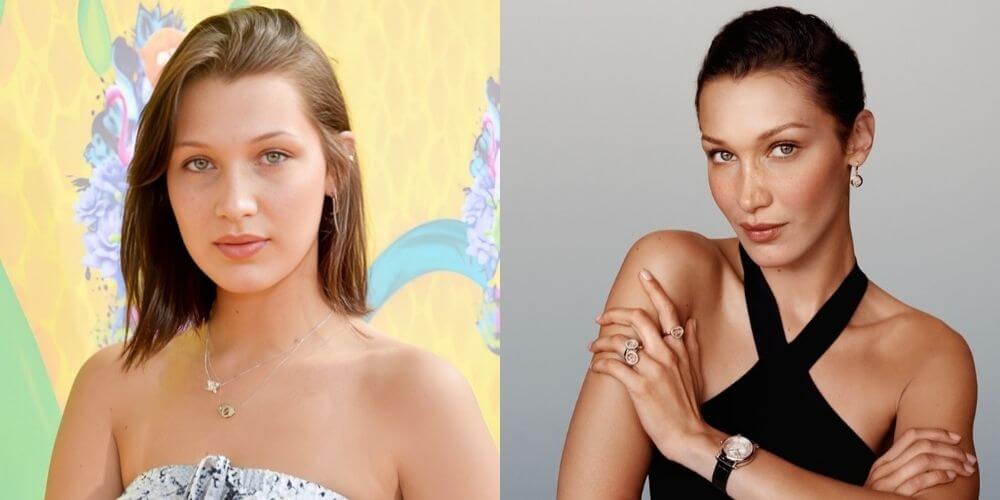 Bella Hadid Before and After Surgery