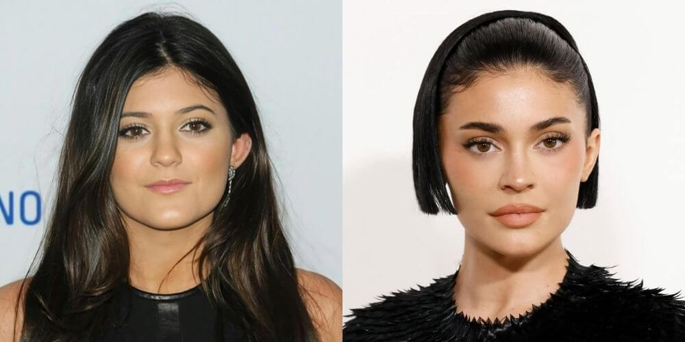 Kylie Jenner Before and After Surgery